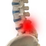 脊柱管狭窄症　腰痛の治療は侍トレーナーズジャパン