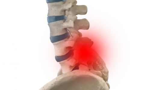 脊柱管狭窄症　腰痛の治療は侍トレーナーズジャパン