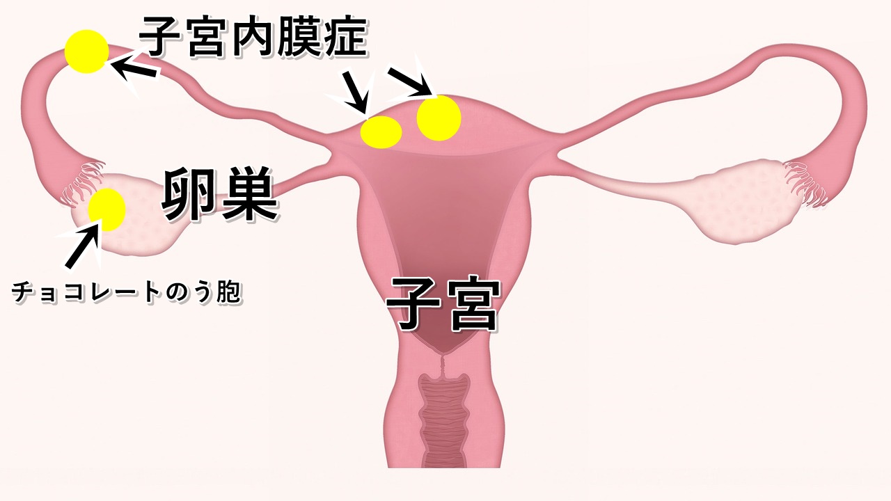 子宮内膜症と診断されて、病院、鍼灸で改善されない方向けに対応。泉大津市の整体院