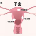 子宮内膜症、子宮筋腫の原因はわからないとなっていますが、土地の磁場との関連性が実はあります