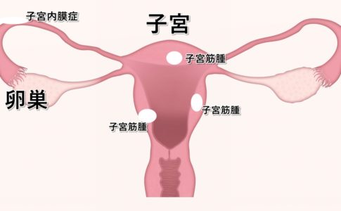 子宮内膜症、子宮筋腫の原因はわからないとなっていますが、土地の磁場との関連性が実はあります