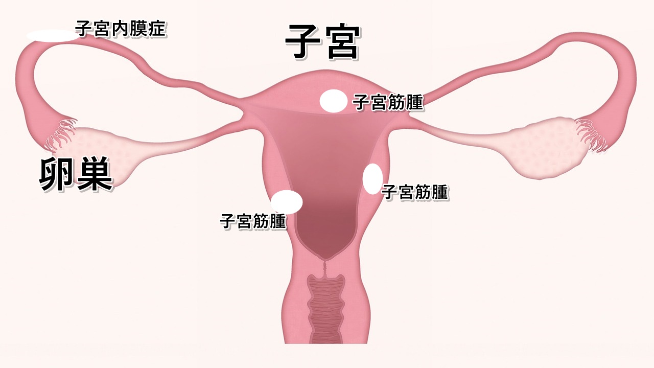 子宮内膜症、子宮筋腫の原因はわからないとなっていますが、土地の磁場との関連性が実はあります